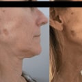 The Amazing Results of Morpheus8: What to Expect After Treatment