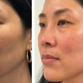 The Ultimate Guide to Morpheus8 Skin Tightening