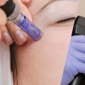 Morpheus8 vs SkinPen: Which Microneedling Treatment is Right for You?