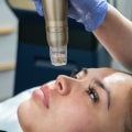 Sylfirm X: The Best Technology for RF Microneedling