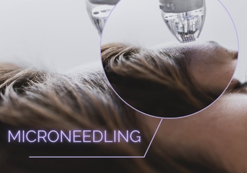 The Ultimate Guide to Choosing the Best RF Microneedling Treatment