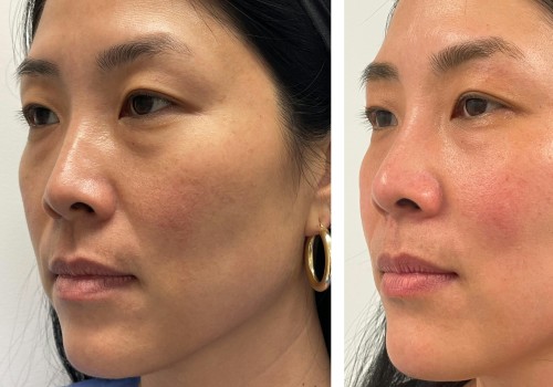 The Ultimate Guide to Morpheus8 Skin Tightening