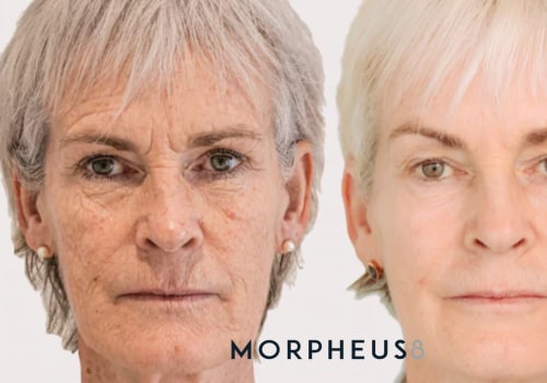 The Long-Lasting Effects of Morpheus8: Expert Insights